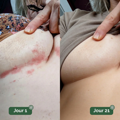 Sérénia™ — Stoppe les brûlures des plis cutanés en 24h