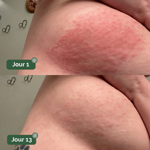 Sérénia™ — Stoppe les brûlures des plis cutanés en 24h